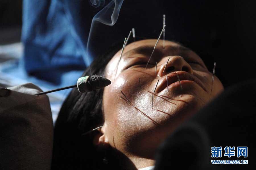 Иглоукалывание китайской медицины распространяется по миру